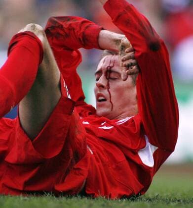 Peter Crouch (Liverpool) liegt mit einer blutenden Kopfverletzung am Boden - EDITORIAL USE ONLY. No use with unauthorised audio, video, data, fixture lists, club league logos or live services. Online in-match use limited to 120 images, no video emulation. No use in betting, games or single club league player publications. Fußball Herren FA Cup 2005 2006, englischer Pokal, Pokalspiel, FC Liverpool Einzelbild Liverpool