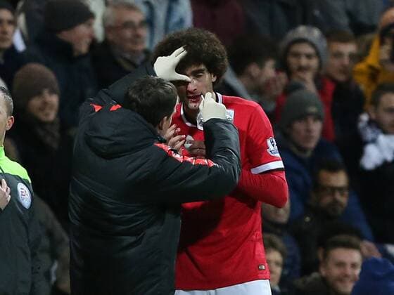 Manchester United ManU s Marouane Fellaini gets a bang on the nose FA Cup - Preston North End vs Manchester United - Deepdale - England - 16th February 2015 - EDITORIAL USE ONLY. No use with unauthorised audio, video, data, fixture lists, club league logos or live services. Online in-match use limited to 120 images, no video emulation. No use in betting, games or single club league player publications.