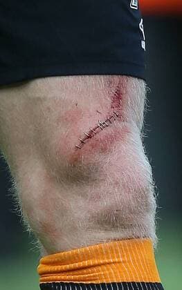 The leg of Paul McShane of Hull City showing the scars of battle after his team where relegated- Barclays Premier League - Hull City vs Manchester Utd - KC Stadium - Hull - England - 24th May 2015 - Picture Simon Bellis Sportimage EDITORIAL USE ONLY. No use with unauthorised audio, video, data, fixture lists, club league logos or live services. Online in-match use limited to 120 images, no video emulation. No use in betting, games or single club league player publications.