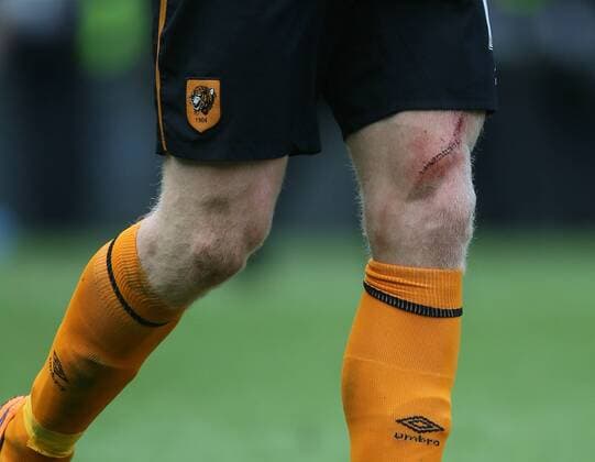 The leg of Paul McShane of Hull City showing the scars of battle after his team where relegated- Barclays Premier League - Hull City vs Manchester Utd - KC Stadium - Hull - England - 24th May 2015 - Picture Simon Bellis Sportimage EDITORIAL USE ONLY. No use with unauthorised audio, video, data, fixture lists, club league logos or live services. Online in-match use limited to 120 images, no video emulation. No use in betting, games or single club league player publications.