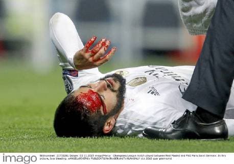 Champions League match played between Real Madrid and PSG Paris Saint Germain. In this picture, Isco bleeding. xANGELxRIVEROx 