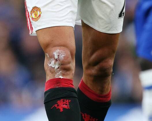 Manchester United ManU s Marouane FellainiÕs cut after getting fouled by ChelseaÕs David LuizÕs tackle during the Premier League match at the Stamford Bridge Stadium, London. Picture date October 23rd, 2016 Pic David Klein Sportimage EDITORIAL USE ONLY. No use with unauthorised audio, video, data, fixture lists, club league logos or live services. Online in-match use limited to 120 images, no video emulation. No use in betting, games or single club league player publications.