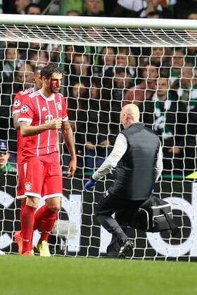 Fußball, CL, Celtic Glasgow - Bayern München, Javi Martinez erleidet Platzwunde Javier Martinez (FC Bayern Muenchen 8) nach dem 1:2 mit einer Platzwunde am Kopf, Celtic Glasgow vs FC Bayern Muenchen, Champions League, Fussball, 31.10.2017, Glasgow Copyright: xLanger Eibner-Pressefotox EP_HLR