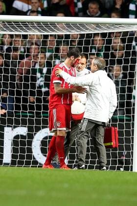 Javier Martinez (FC Bayern Muenchen 8) nach dem 1:2 mit einer Platzwunde am Kopf, Celtic Glasgow vs FC Bayern Muenchen, Champions League, Fussball, 31.10.2017, Glasgow Copyright: xLanger Eibner-Pressefotox EP_HLR