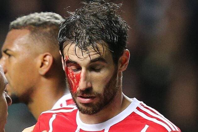Themen der Woche - SPORT Bilder des Tages - SPORT Fußball, CL, Celtic Glasgow - Bayern München, Javi Martinez erleidet Platzwunde l-r: Mannschaftsarzt Dr. Volker Braun (FC Bayern Muenchen) behandelt Javi Martinez 8 (FC Bayern Muenchen) am Auge, Blut, Celtic Glasgow vs. FC Bayern Muenchen, Fussball, Vorrunde, Champions League, 31.10.2017 Glasgow Glasgow Schottland