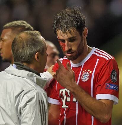 Fußball, CL, Celtic Glasgow - Bayern München, Javi Martinez erleidet Platzwunde 31.10.2017, Fussball UEFA Champions League 2017 2018, Gruppenphase, 4.Spieltag, Celtic Glasgow - FC Bayern München, im Celtic-Park Stadion Glasgow, Schottland. Nach seinem Tor zum 2:1 muss Javi Martinez (re, FC Bayern München) mit blutender Kopfverletzung behandelt werden.