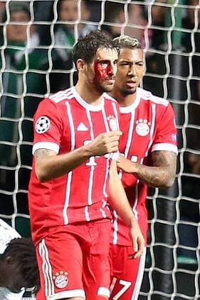 Bilder des Tages - SPORT Fußball, CL, Celtic Glasgow - Bayern München, Javi Martinez erleidet Platzwunde Javier Martinez (FC Bayern Muenchen 8) nach dem 1:2 mit einer Platzwunde am Kopf Jerome Boateng (FC Bayern Muenchen 17), Celtic Glasgow vs FC Bayern Muenchen, Champions League, Fussball, 31.10.2017, Glasgow Copyright: xLanger Eibner-Pressefotox EP_HLR