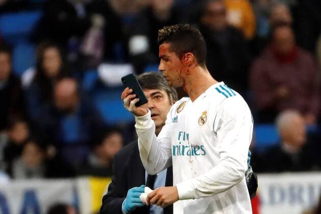 Themen der Woche - SPORT Bilder des Tages - SPORT Real Madrid s Portuguese striker Cristiano Ronaldo uses a cellphone to check a wound in his face during a Spanish league La Liga soccer match between Real Madrid and Deportivo at Santiago Bernabeu stadium in Madrid, Spain, 21 January 2018. Real Madrid vs Deportivo !ACHTUNG: NUR REDAKTIONELLE NUTZUNG!  Copyright: xJuanxCarlosxHidalgox GRAF4158 20180121-636521578355751076