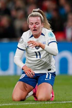Sport Bilder des Tages England Women v Brazil Women Womens Finalissima 2023 Lauren Hemp of England gets a bloody nose during the Womens Finalissima 2023 match between England Women and Brazil Women at Wembley Stadium, London Content Not Available For UK Newspapers Copyright: xPaulxChestertonx FIL-18329-0071 UK Newspapers OUT