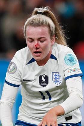 England Women v Brazil Women Womens Finalissima 2023 Lauren Hemp of England gets a bloody nose during the Womens Finalissima 2023 match between England Women and Brazil Women at Wembley Stadium, London Content Not Available For UK Newspapers Copyright: xPaulxChestertonx FIL-18329-0072 UK Newspapers OUT