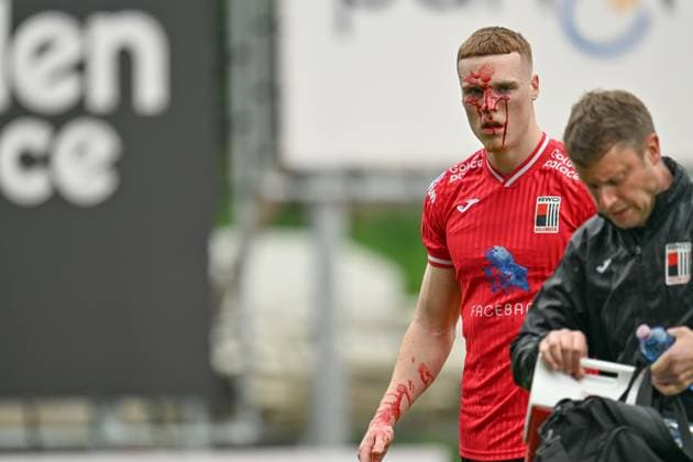 Sport Themen der Woche KW15 RWDM s Jake O Brien leaving the pitch with a bleeding nose during a soccer match between RWDM and SK Beveren, Sunday 16 April 2023 in Brussels, on day 7 (out of 10) of the Promotion Play-Offs of the 2022-2023 Challenger Pro League 1B second division of the Belgian championship. DAVIDxCATRY  x65017079x