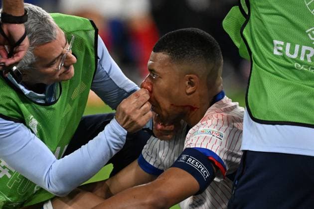 17.06.2024, xjhx, Fussball EM 2024, Österreich - Frankreich emspor, v.l. Kylian Mbappe Lottin (Frankreich) mit Schmerzen, verletzt, Verletzung blutet Nase Nasenbluten (DFL DFB REGULATIONS PROHIBIT ANY USE OF PHOTOGRAPHS as IMAGE SEQUENCES and or QUASI-VIDEO) Düsseldorf