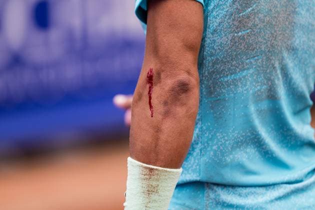 240718 A wound on Rafael Nadal arm during day 4 of the Nordea Open on July 18, 2024 in Bastad. Photo: Niclas Jönsson BILDBYRAN COP 273 NO0288 tennis ATP, Tennis Herren 250 nordea open bbeng Copyright: NICLASxJÖNSSON BB240718NO073