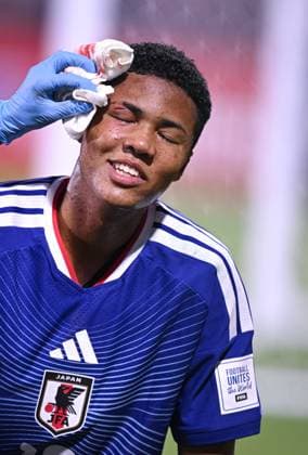 Fussball, Junioren U 17 WM 2025 Doha Katar Sechzehntelfinal 15.11.2025 Spiel 82 Japan - Suedafrika Simon Yu Mendy (Japan) muss mit einer Platzwunde am Kopf ausgewechselt werden.