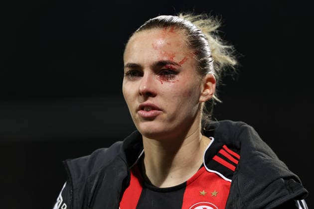 FBL - Frauen-Bundesliga Eintracht Frankfurt and TSG Hoffenheim Laura Freigang (Eintracht Frankfurt) is injured in the eye during the Google Pixel Frauen Bundesliga match between Eintracht Frankfurt and TSG Hoffenheim on March 18, 2026, at Stadion am Brentanobad in Frankfurt am Main, Germany Copyright: JoaquimxFerreira