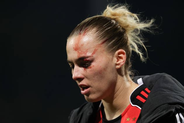 FBL - Frauen-Bundesliga Eintracht Frankfurt and TSG Hoffenheim Laura Freigang (Eintracht Frankfurt) is injured in the eye during the Google Pixel Frauen Bundesliga match between Eintracht Frankfurt and TSG Hoffenheim on March 18, 2026, at Stadion am Brentanobad in Frankfurt am Main, Germany Copyright: JoaquimxFerreira