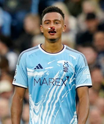 Birmingham, England, 12th September 2026. Dan Ndoye of Nottingham Forest with a nose injury during the Aston Villa vs Nottingham Forest Premier League match at Villa Park, Birmingham. Picture credit should read: Andrew Yates Sportimage EDITORIAL USE ONLY. No use with unauthorised audio, video, data, fixture lists, club league logos or live services. Online in-match use limited to 120 images, no video emulation. No use in betting, games or single club league player publications. SPI_018_AY_Villa_Forest SPI-4990-0018