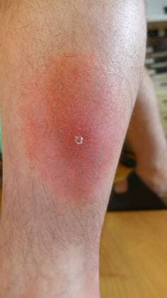 gefaehrliche Roetung einer Borrelioseinfektion an einem Bein nach Zeckenbiss, Deutschland dangerous flush of an infection of borreliosis at a leg after tick bite, Germany BLWS347229