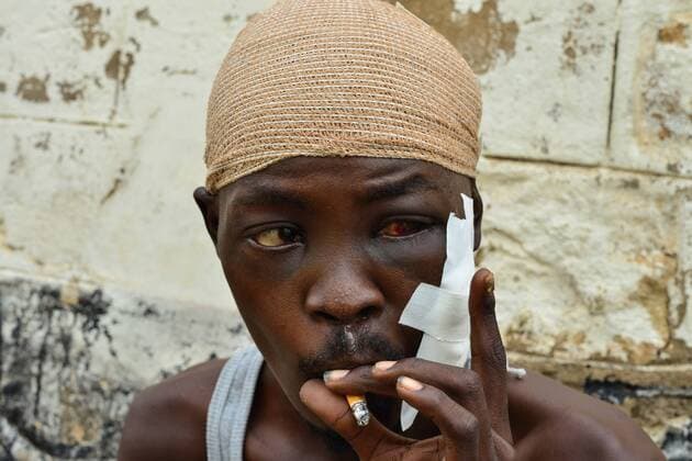 June 28, 2017 - Juba, Jubek, South Sudan - ABEL TUKU, 26, takes a cigarette break on the sidewalk of the recovery ward of Juba general hospital in South Sudan Wednesday. Tuku was shot in the face during a robbery at the Tabasa neighborhood in the outskirts of Juba, the thieves took away 1 dollar when assaulted him the 20th of this month. Juba South Sudan - ZUMAl113 20170628_637_l113_006 Copyright: xMiguelxJuarezxLugox