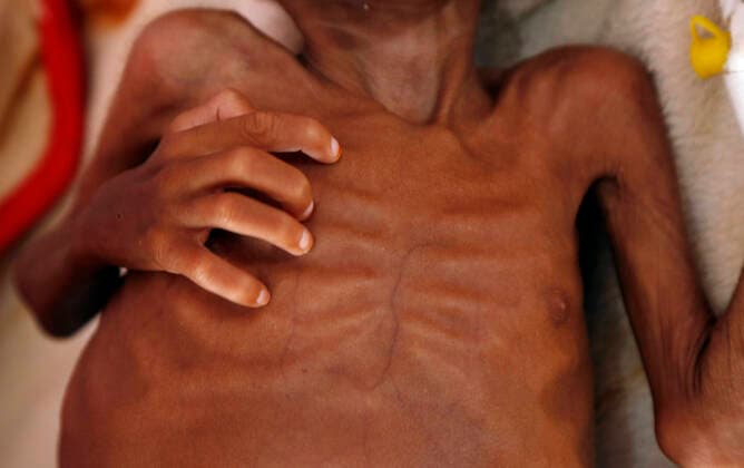 (191017) -- SANAA, Oct. 17, 2019 (Xinhua) -- A Yemeni malnourished child lies on a bed as he receives medical treatment at the malnutrition treating department in Al-Sabeen hospital in Sanaa, Yemen, Oct. 17, 2019. At least one in three children under five across the globe are malnourished and not developing properly, the United Nations Children s Fund (UNICEF) revealed on Tuesday. Oct. 17 marks the 27th International Day for the Eradication of Poverty. (Photo by Mohammed Mohammed Xinhua) YEMEN-SANAA-CHILDREN-MALNUTRITION 