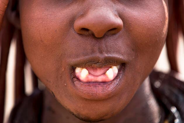 IMAGO Cultures of the world, Himba Volk in Namibia Details of Himba woman s teeth, from the Himba Community. Northern Kaokoland. Namibia. In the Himba culture, it s very common to remove the 4 teeth from the lower jaw, it also aids better pronunciation of certain words.  1561644 ChristophexCourteau