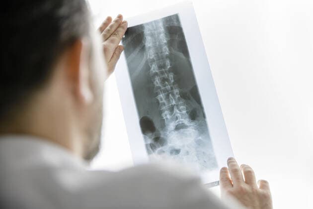 Symbolbild: Das Roentgenbild einer Wirbelsaeule mit diagnostizierter Skoliose wird vor einer Leuchtflaeche gehalten. Berlin, 22.01.2020 Berlin Deutschland *** Symbol image The red gene image of a spinal column with diagnosed scoliosis is held in front of a luminous surface Berlin, 22 01 2020 Berlin Germany Copyright: xThomasxTrutschel photothek.dex
