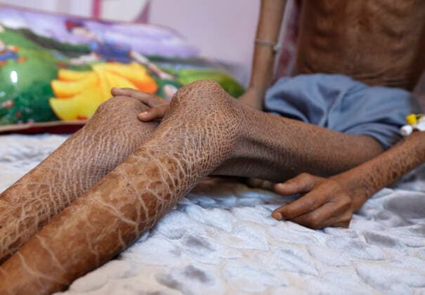 IMAGO Creative: Hunger (200228) -- SANAA, Feb. 28, 2020 (Xinhua) -- Mohammed Hassan, a malnourished child, sits on a bed as he receives medical treatment at the malnutrition ward in Al-Sabeen hospital in Sanaa, Yemen, Feb. 25, 2020. The United Nations says about 80 percent of the Yemeni population are in need of life-saving support. About 7.4 million people need nutrition assistance, including 2.1 million children under the age of five, and 1.1 million pregnant and breastfeeding women who need acute malnutrition treatment, Stephane Dujarric, spokesman for United Nations Secretary-General Antonio Guterres, said in a statement in January. TO GO WITH Feature: Children first victims when famine knocks Yemen s doors (Photo by Mohammed Mohammed Xinhua) YEMEN-SANAA-CHILDREN-MALNUTRITION 