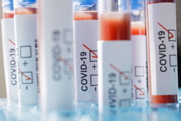 Gestellte Aufnahme. Symbolfoto: Coronavirus Diagnose. COVID-19, SARS-CoV-2. Berlin, 05.03.2020 Berlin Deutschland