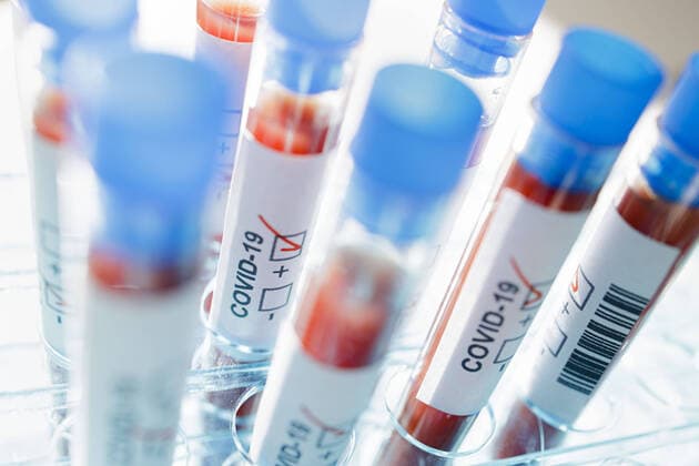 Gestellte Aufnahme. Symbolfoto: Coronavirus Diagnose. COVID-19, SARS-CoV-2. Berlin, 05.03.2020 Berlin Deutschland