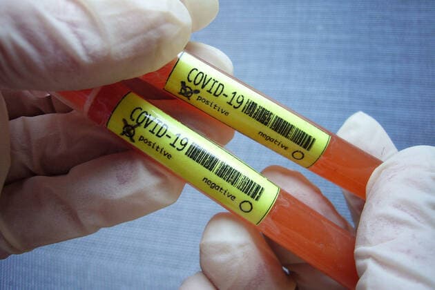 SYMBOLFOTO: Inzwischen sind in fast allen Bundeslaendern Infektionsfaelle mit dem neuen Coronavirus Covid-19 (SARS-CoV-2) bestaettigt worden. Test,Ampullen,Bluttest,Corona Test.
