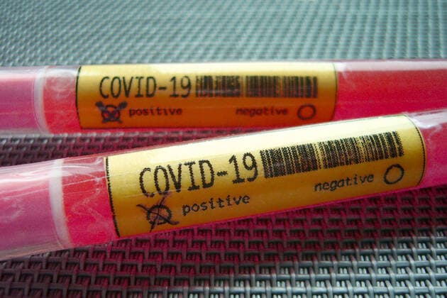 SYMBOLFOTO verfremdet. Inzwischen sind in fast allen Bundeslaendern Infektionsfaelle mit dem neuen Coronavirus Covid-19 (SARS-CoV-2) bestaettigt worden. Test,Ampullen,Bluttest,Corona Test.