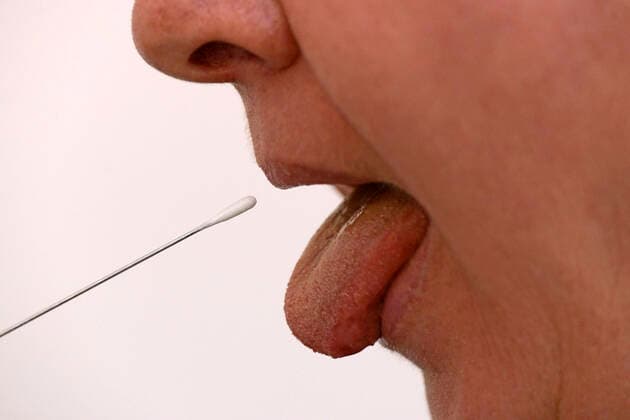 22.03.2020, Abstrichtest an der Zunge mit Teststäbchen bei einer Probandin. 22.03.2020, Abstrichtest 22.03.2020, Abstrichtest