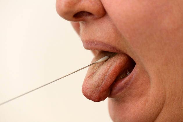 22.03.2020, Abstrichtest an der Zunge mit Teststäbchen bei einer Probandin. 22.03.2020, Abstrichtest 22.03.2020, Abstrichtest