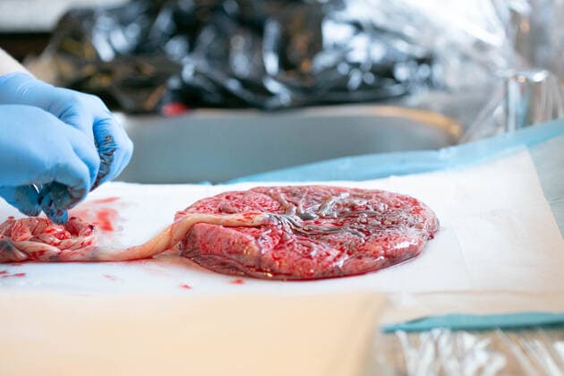 Gloved hands with placenta on white pad attached to umiblical cord. Bellingham, WA, United States CR_REBE200302B-320025-01