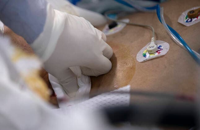 Coronavirus in China, Eindrücke aus einem Krankenhaus in Wuhan (200406) -- WUHAN, April 6, 2020 -- Medical staff press the wound to prevent it from bleeding after taking off the ECMO machine used to support senior Hu s lungs at the Wuhan pulmonary hospital in Wuhan, capital of central China s Hubei Province, April 5, 2020. A patient surnamed Hu, a 40-year-old severe case of the COVID-19 who was diagnosed with the disease in early February, has the functions of his lungs recovered on Sunday at the Wuhan pulmonary hospital with days of extracorporeal membrane oxygenation (ECMO) support. ) CHINA-WUHAN-COVID-19-SEVERE CASE-LUNG FUNCTIONS-RECOVERY (CN) FeixMaohua 
