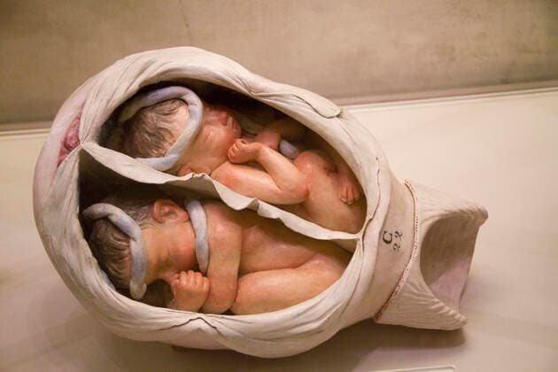 Clay model of a human uterus showing twin fetuses with the umbilical cord wrapped around one of them dating to the 1700 s by Giovan Galli to teach doctors and mdiwives and now part of the Obsterical Museum of the Univerity of Bologna in the Pallazo Poggi.Bologna,Italy Copyright: xHalxBeralx V&W-IT-308