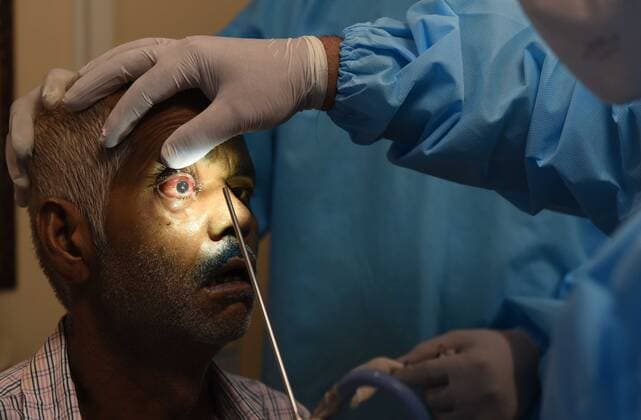 Coronavirus in Indien, landesweite Eindrücke GHAZIABAD, INDIA - JUNE 3: ENT specialist Dr. Brajpal Singh Tyagi examines a patient who recovered from Covid-19 prior to a surgery to remove Mucormycosis (Black Fungus), at a hospital on June 3, 2021 in Ghaziabad, India. Black fungus, also known as Mucormycosis, is a rare but dangerous infection. Black fungus is caused by getting into contact with fungus spores in the environment. According to medical experts, the main cause of black fungus (mucormycosis) is steroid misuse during COVID treatment. (Photo by Ajay Aggarwal Hindustan Times) Treatment Of Mucormycosis Black Fungus Patients