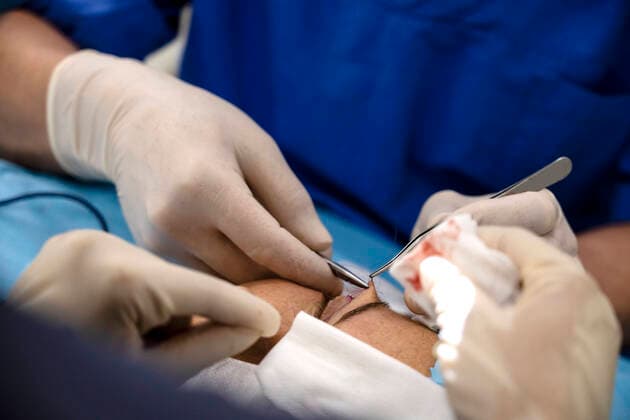 Plastic surgery operation, modifying the eye region in medical clinic Barcelona, Catalonia, Spain CR_RAFE210906-815157-01 ,model released, Symbolfoto