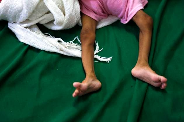 IMAGO Creative: Hunger (211124) -- HODEIDAH, Nov. 24, 2021 -- An acutely malnourished child lies on a bed in the al-Thawrah hospital in Hodeidah, the Red Sea port city of Yemen, Nov. 20, 2021. (Photo by Xinhua) YEMEN-HODEIDAH-CHILDREN-MALNUTRITION MohammedxMohammed 