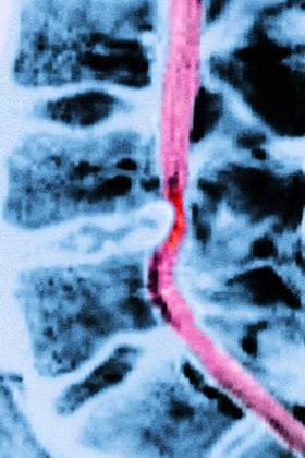 Herniated disc between L4-L5 lumbar vertebrae (lesion compressing the spinal cord by displacement of part of an intervertebral disc outside the limits of its normal situation). Lumbar spinal MRI in sagittal section. CAVALLINIxJAMESx xBSIP 016319_026 941_04_Bsip_016319_026