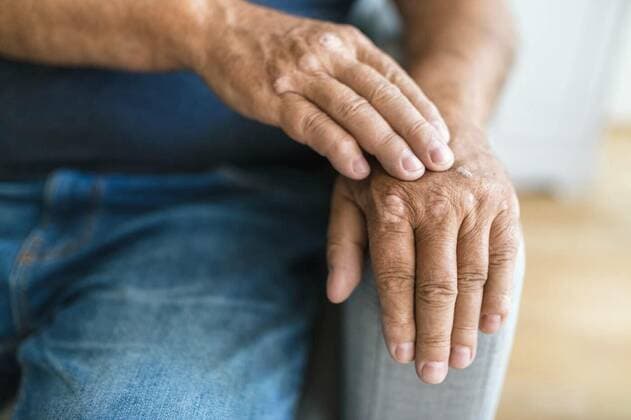 Elderly man suffering from psoriasis on hands, Elderly man suffering from psoriasis, closeup on hands, Elderly man suffering from psoriasis, closeup on hands model released, Symbolfoto , 01.06.2022, Copyright: xtommyandonex Panthermedia31470695.jpg