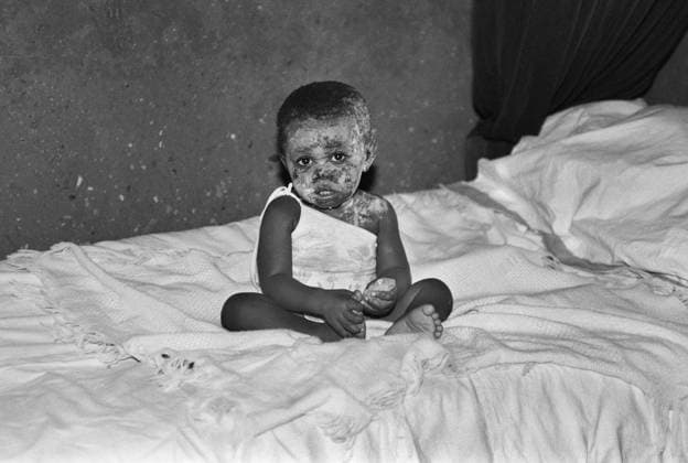 Angola, Jamba, 05.04.1992 Archiv.: 33-07-32 Stadtfotos Foto: verletztes Kind in der Klinik in Jamba Stadtfotos *** Angola, Jamba, 05 04 1992 archive 33 07 32 city photos photo injured child in clinic in Jamba city photos