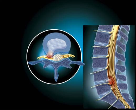 slipped disc Medical illustration showing a lumbar disc herniation at the level of L4-L5 compressing the nerves of the ponytail. The lumbar disc herniation (contents of the nucleus of the vertebral disc that protrudes behind the vertebra in the vertebral canal and compresses the root of the nerve, causing inflammation) represents 90% of the causes of sciatica. In this illustration the hernia on the left is represented on a superior view of a lumbar vertebra. On the right, it is represented on a median sagittal section of the lumbar spine and the beginning of the sacred column . Copyright: xJACOPINx xBSIPx 015937_001 Bsip_015937_001