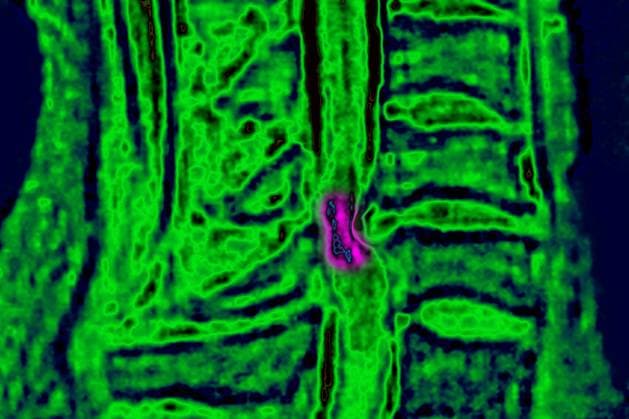 HERNIATED DISK, MRI Cord compression between the 5th and 6th cervical vertebrae caused by a herniated disc. Sagittal plane MRI scan. Copyright: xCAVALLINIxJAMESx xBSIPx 015324_046 Bsip_015324_046