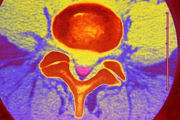 Slipped disc Slipped disc compression of the medulla lumbar vertebra. Copyright: xCAVALLINIxJAMESx xBSIPx 015759_042 Bsip_015759_042