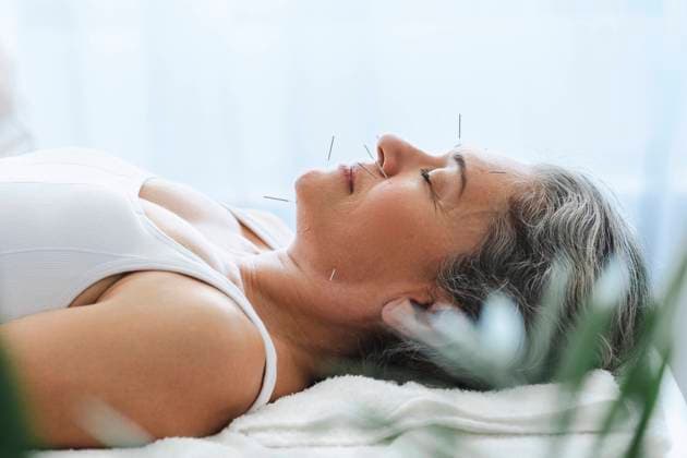 Woman undergoing acupuncture treatment at health spa model released, Symbolfoto property released, AAZF02060