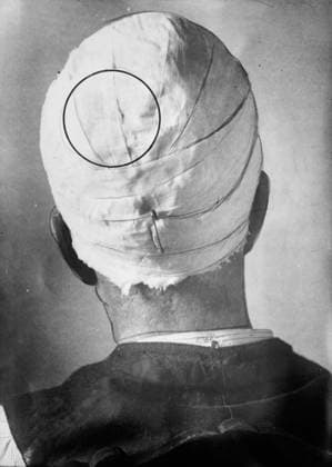 RECORD DATE NOT STATED George Kimmel, between c1910 and 1912. Shows George Kimmel who underwent surgery to cure his amnesia. Copyright:xHeritagexArt HeritagexImagesxBainxNewsxServicex IMAGO, ! ACHTUNG: AUFNAHMEDATUM GESCHÄTZT!  Copyright:HeritagexArt HeritagexImagesxBainxNewsxServicex IMAGO