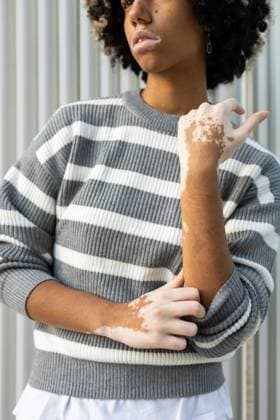 Creative Highlights Symbolbilder 783449156 A mixed race woman with vitiligo relaxes on a university campus, enjoying a calm day The image captures the beauty and diversity of student life in an academic setting Model Released DavidMunoz_ID25207_729123_002 Copyright: xDavidxMunozx