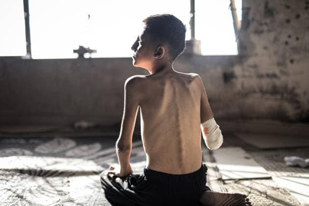 Bilder des Jahres 2025, News 06 Juni News Themen der Woche KW23 News Bilder des Tages Palestinian Ahmad, 14, injured in Gaza, awaits treatment GAZA CITY, GAZA - MAY 31: Ahmad Falih Versh Agha, a 14-year-old boy living in a shelter on Rashid Street, west of Gaza City, who was seriously wounded in the attack on his school, is viewed on May 31, 2025 in Gaza City, Gaza. Ahmad, who lost his right arm in the attack, suffered shrapnel damage to his intestines and a broken pelvis. Ahmad, who lost his father in a previous attack, struggles with health problems due to malnutrition. Ahmad, who needs a prosthetic arm, hopes to be treated abroad. Ahmed Jihad Ibrahim Al-arini Anadolu Gaza City Gaza. Editorial use only. Please get in touch for any other usage.  Copyright: x2025xAnadoluxAhmedxJihadxIbrahimxAl-arinix