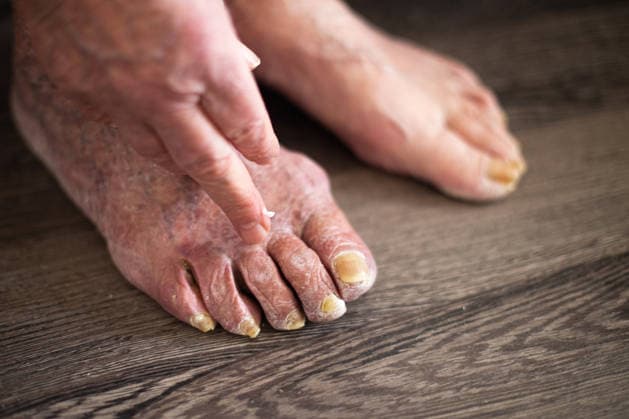 Eine ältere Person, die eine Salbe gegen eine Fußpilzinfektion aufträgt Older senior elderly person applying medicinal cream to toenails afflicted with onychomycosis. Legs treatment with fungal foot infection. (License=RF) ,model released, Symbolfoto Copyright: xZoonar.com SvetaxG.x 24879581 ,model released, Symbolfoto ,property released